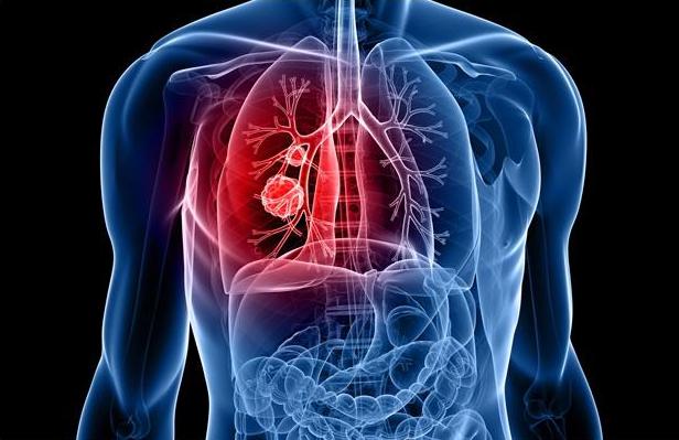 必看！7種肺癌可能出現的早期症狀