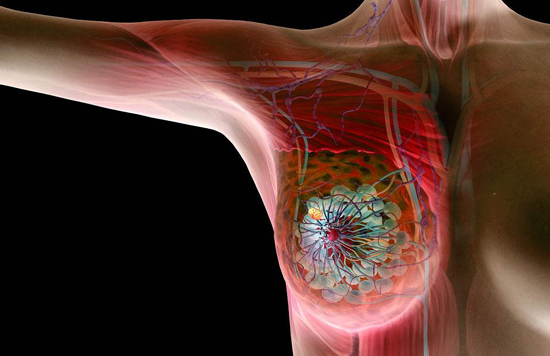 關於乳腺癌的4個早期症狀,早點知道能救命!